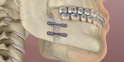 Illustration of mandibular advancement surgery