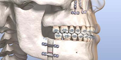 Illustration showing results of both upper and lower jaw surgery