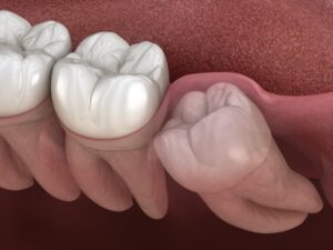 close-up of a sideways wisdom tooth 